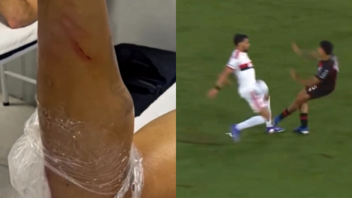 Flamengo divulga "estrago" causado na canela de Lucas Paquetá