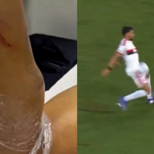 Flamengo divulga "estrago" causado na canela de Lucas Paquetá